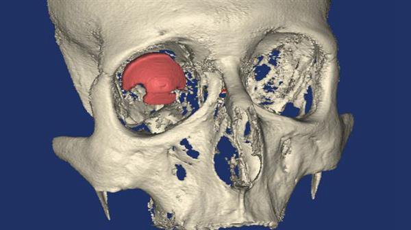 3D打印技術(shù)在醫(yī)療方面的應(yīng)用 世界首個(gè)3D打印義眼_E鍵3D打印服務(wù)