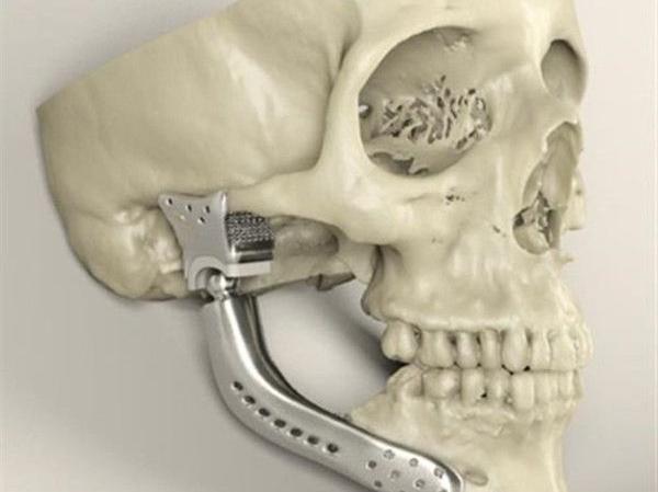 簡述3D打印技術(shù)在醫(yī)療行業(yè)應(yīng)用情況_e鍵3D打印服務(wù)