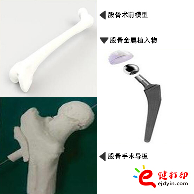 股骨金屬植入物