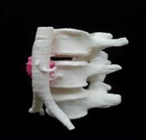 腰椎金屬植入物3